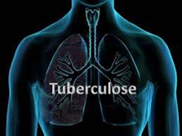 Saúde. Foram registados 247 casos de tuberculose em 2017